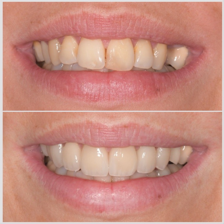 Cas clinique — Inlays-Onlays