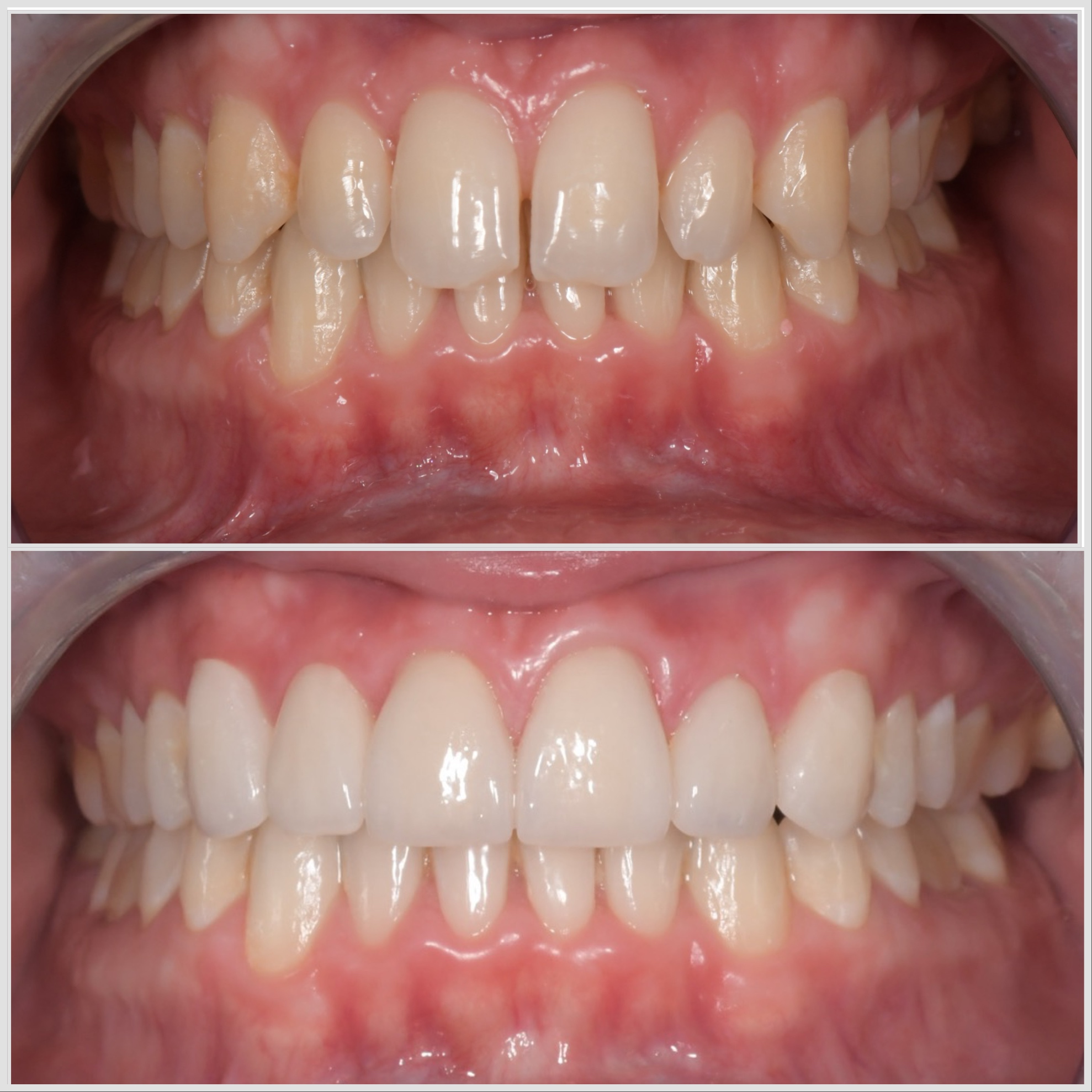 Cas clinique — Implantologie